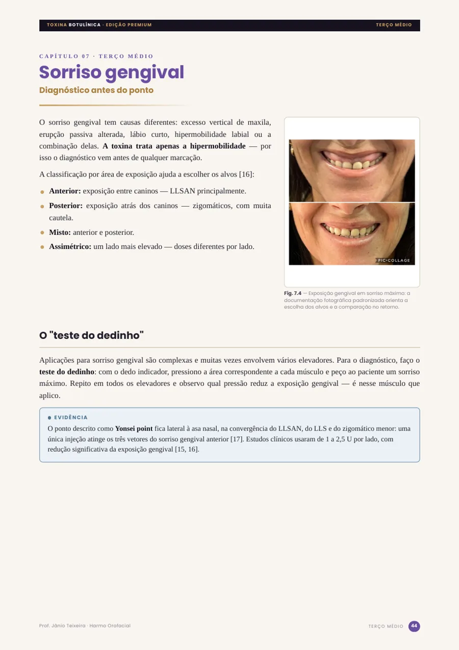 Sorriso gengival